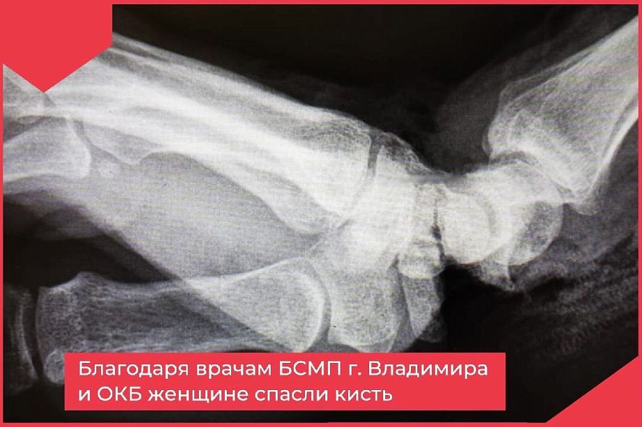 Действия владимирских врачей спасли женщине руку с отрубленной кистью